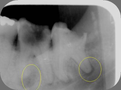 absceso